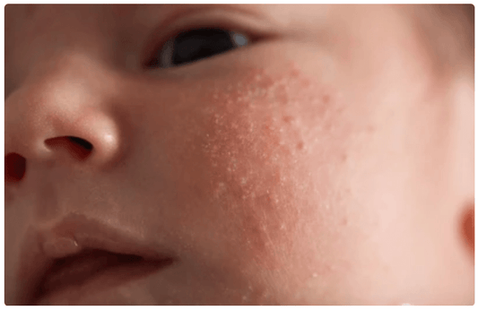 Comprendre et traiter l’acné du nourrisson