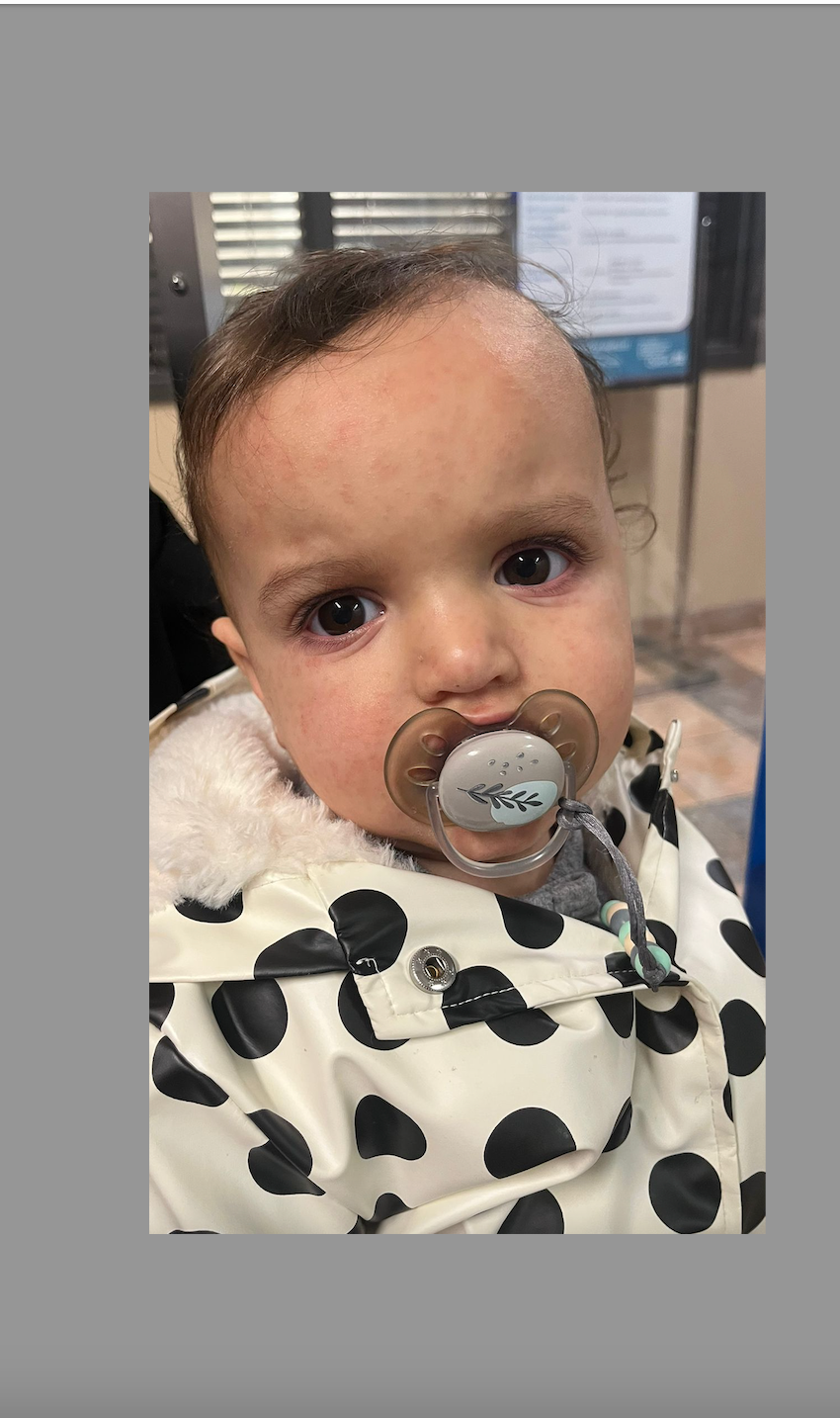 Boutons de chaleur chez bébé: les reconnaitre, les prévenir et les soulager